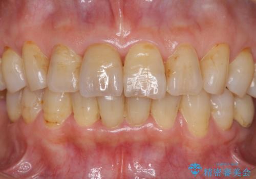 天然歯を模した ハイグレードオールセラミッククラウンの治療後