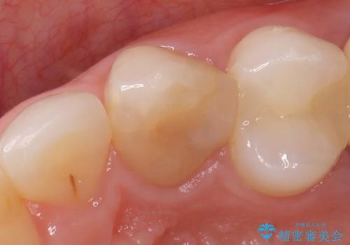 オールセラミッククラウン(スペシャル) より綺麗な歯への治療前