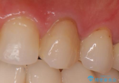 オールセラミッククラウン(スペシャル) より綺麗な歯への治療前