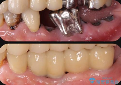 虫歯による歯の喪失　インプラントによる咬合機能回復