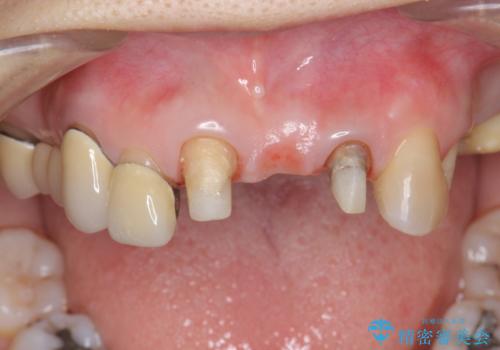 前歯ブリッジのやりかえの治療中