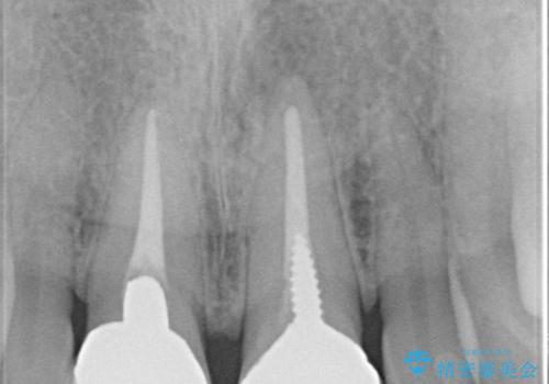 前歯をメタルフリーに　根管治療で不安を取り除いてからの治療前