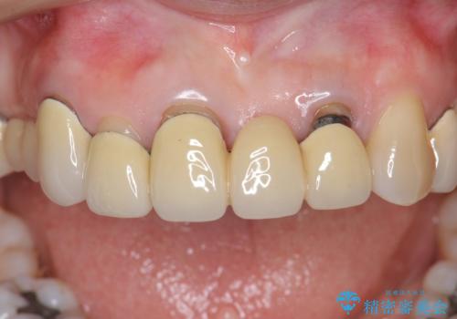 前歯ブリッジのやりかえの治療前