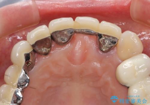 前歯ブリッジのやりかえの治療前