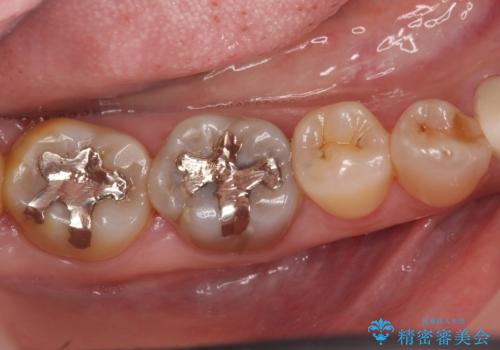 オールセラミッククラウン・セラミックインレー 口腔内全体の見た目の改善の治療前