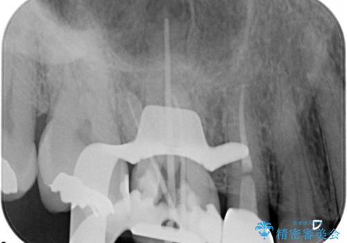 奥歯の根管治療~オールセラミッククラウンの治療中
