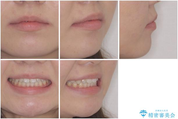 矯正治療とインプラント治療を同時に 総合歯科診療の治療後(顔貌)