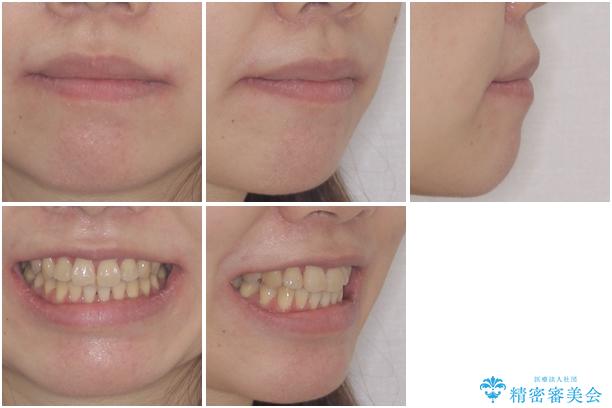 ハーフリンガル 反対咬合の改善の治療後(顔貌)