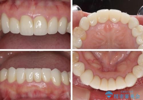 この際全てをしっかりと治療したい 総合歯科治療の治療後