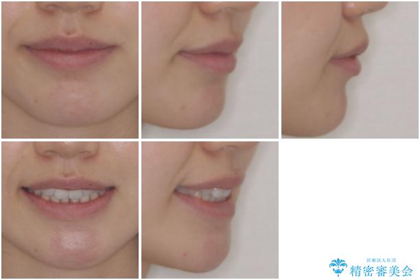 オープンバイトのインビザラインを用いた再矯正 の治療後(顔貌)