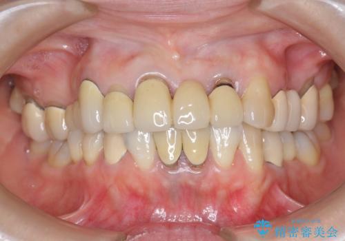 前歯ブリッジのやりかえの治療前