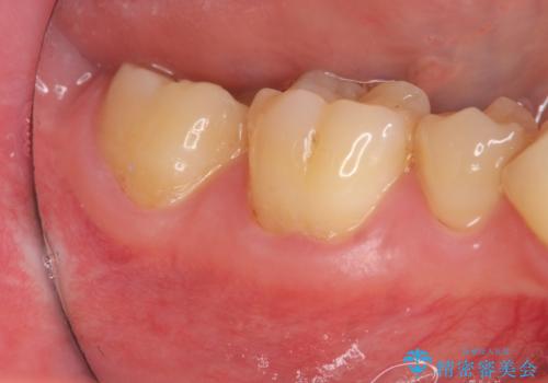 歯ぐきが下がり歯がしみる　歯肉移植による治療の症例 治療前