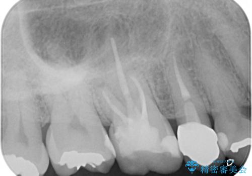奥歯の根管治療～オールセラミッククラウンの治療後