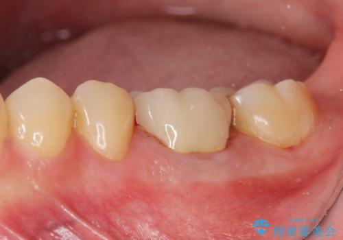 放置してしまった歯　根管治療からの機能回復の治療後