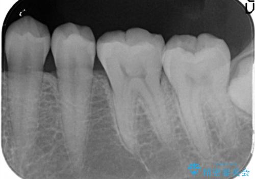 詰め物が外れた セラミックによる精密な修復の治療後