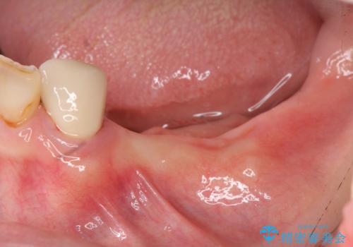 [嘔吐反射がひどく義歯がつけられない] 臼歯部インプラント補綴　の症例 治療前