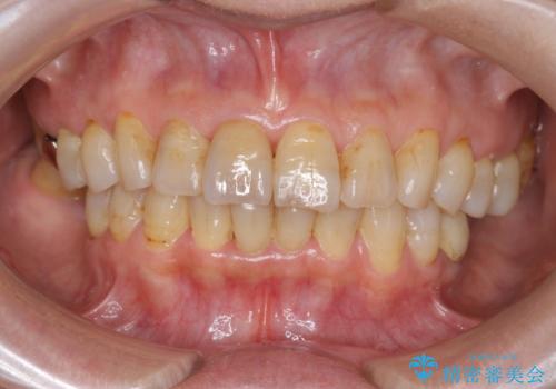 天然歯を模した ハイグレードオールセラミッククラウンの治療後