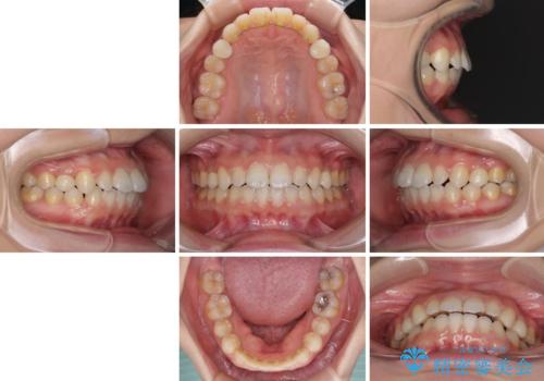 矯正治療とインプラント治療を同時に 総合歯科診療の治療後