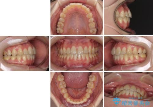 ハーフリンガル 反対咬合の改善の治療後