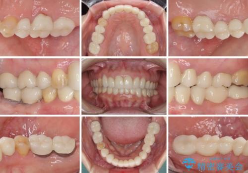 この際全てをしっかりと治療したい 総合歯科治療の治療後