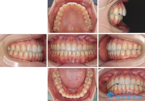 オープンバイトのインビザラインを用いた再矯正 の治療後