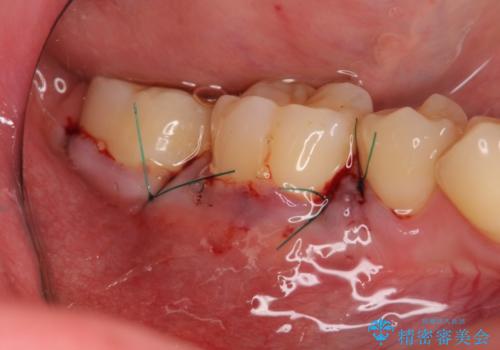 歯ぐきが下がり歯がしみる 歯肉移植による治療の治療中