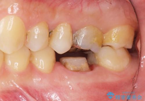 放置してしまった歯 根管治療からの機能回復の治療中