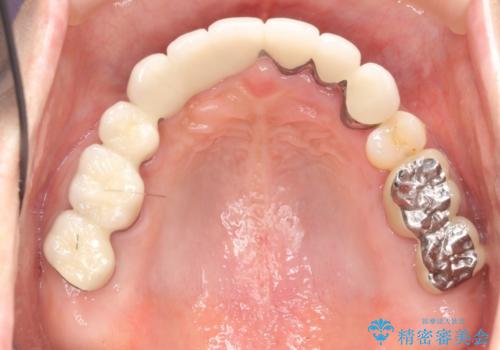 咬合性外傷による歯槽骨吸収 ブリッジ補綴の症例 治療後