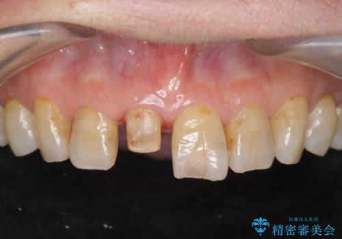 天然歯を模した ハイグレードオールセラミッククラウンの治療中