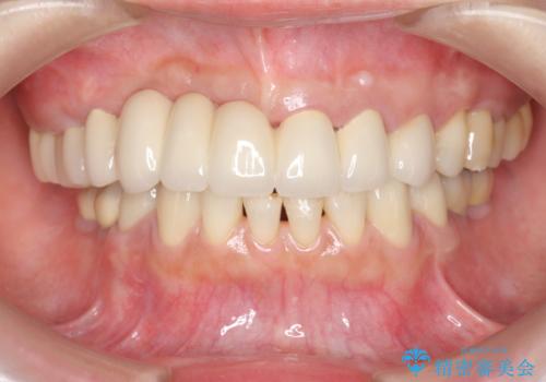 咬合性外傷による歯槽骨吸収 ブリッジ補綴の治療後