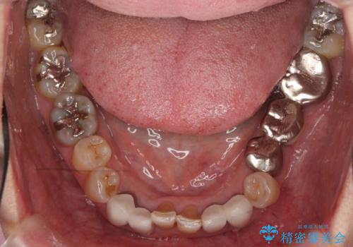 オールセラミッククラウン・セラミックインレー 口腔内全体の見た目の改善の治療前