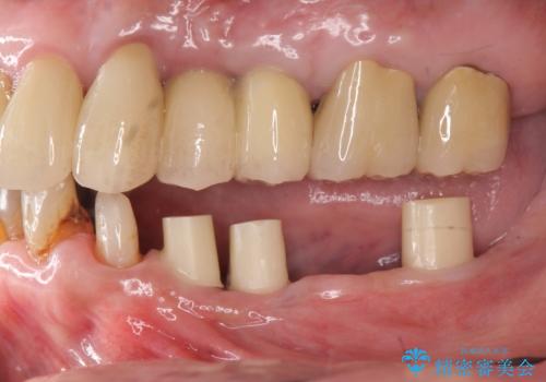 虫歯による歯の喪失 インプラントによる咬合機能回復の治療中