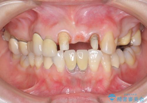 前歯ブリッジのやりかえの治療中