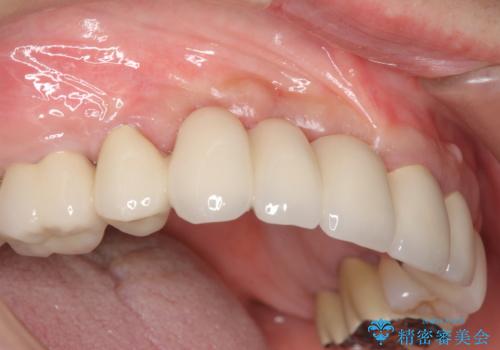 咬合性外傷による歯槽骨吸収 ブリッジ補綴の治療後