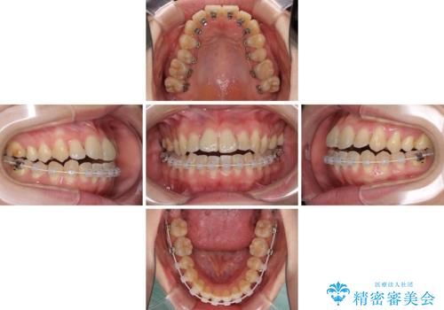 ハーフリンガル 反対咬合の改善の治療中