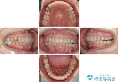 この際全てをしっかりと治療したい 総合歯科治療の治療中