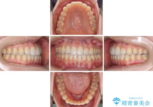 オープンバイトのインビザラインを用いた再矯正 の治療中
