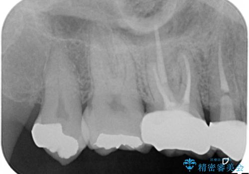 奥歯の根管治療～オールセラミッククラウンの症例 治療後