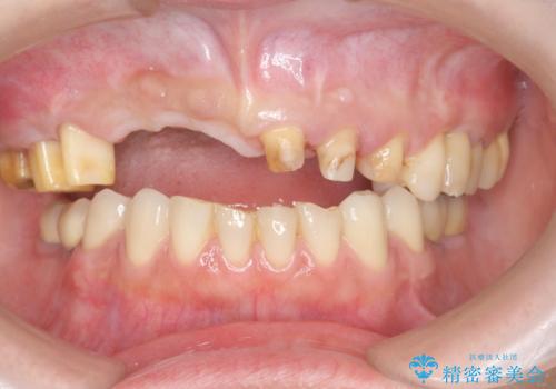 咬合性外傷による歯槽骨吸収 ブリッジ補綴の治療前