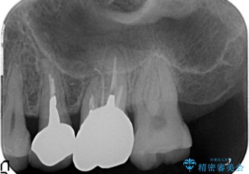 奥歯が痛い。根管治療~オールセラミッククラウンの治療の治療前