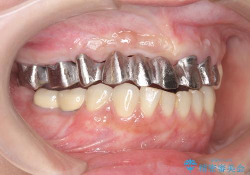 咬合性外傷による歯槽骨吸収 ブリッジ補綴の治療中