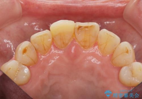 天然歯を模した ハイグレードオールセラミッククラウンの治療前