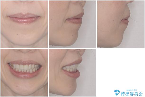この際全てをしっかりと治療したい 総合歯科治療の治療後(顔貌)