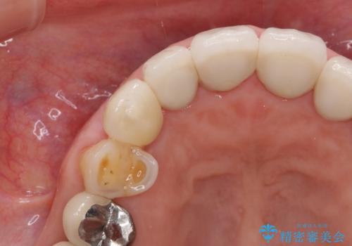 クラウン下に再発した深い虫歯 インプラントによる機能回復の治療後