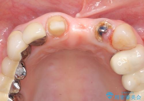 前歯ブリッジのやりかえの治療中