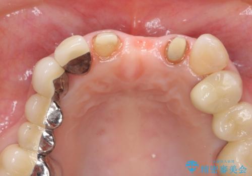 前歯ブリッジのやりかえの治療中