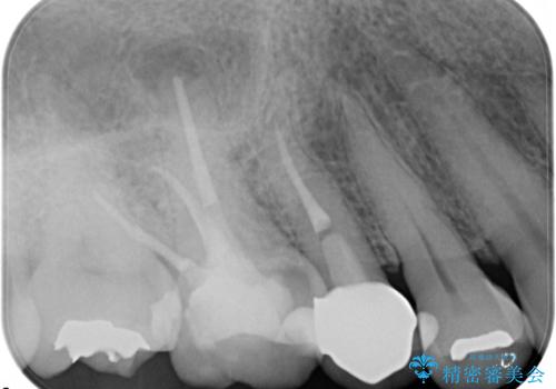 奥歯の根管治療~オールセラミッククラウンの治療後