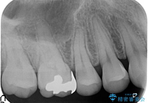 セラミックインレー メタルフリーの治療の治療前