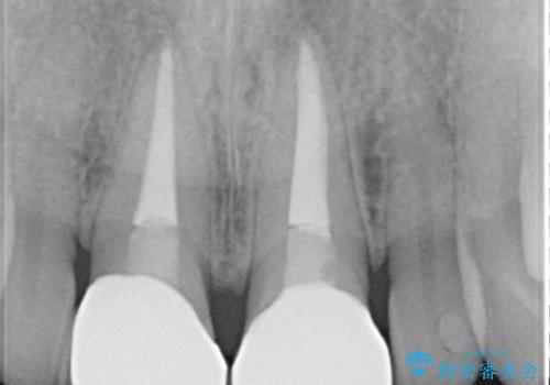 前歯をメタルフリーに　根管治療で不安を取り除いてからの治療後