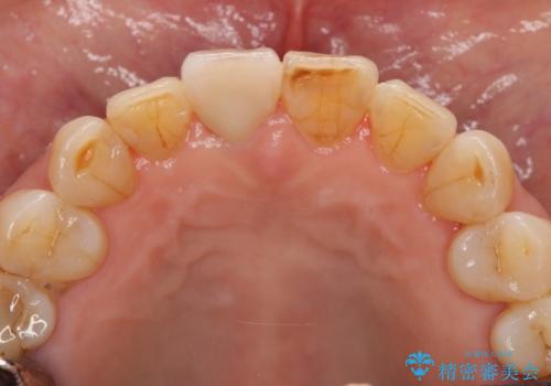 天然歯を模した ハイグレードオールセラミッククラウンの治療後